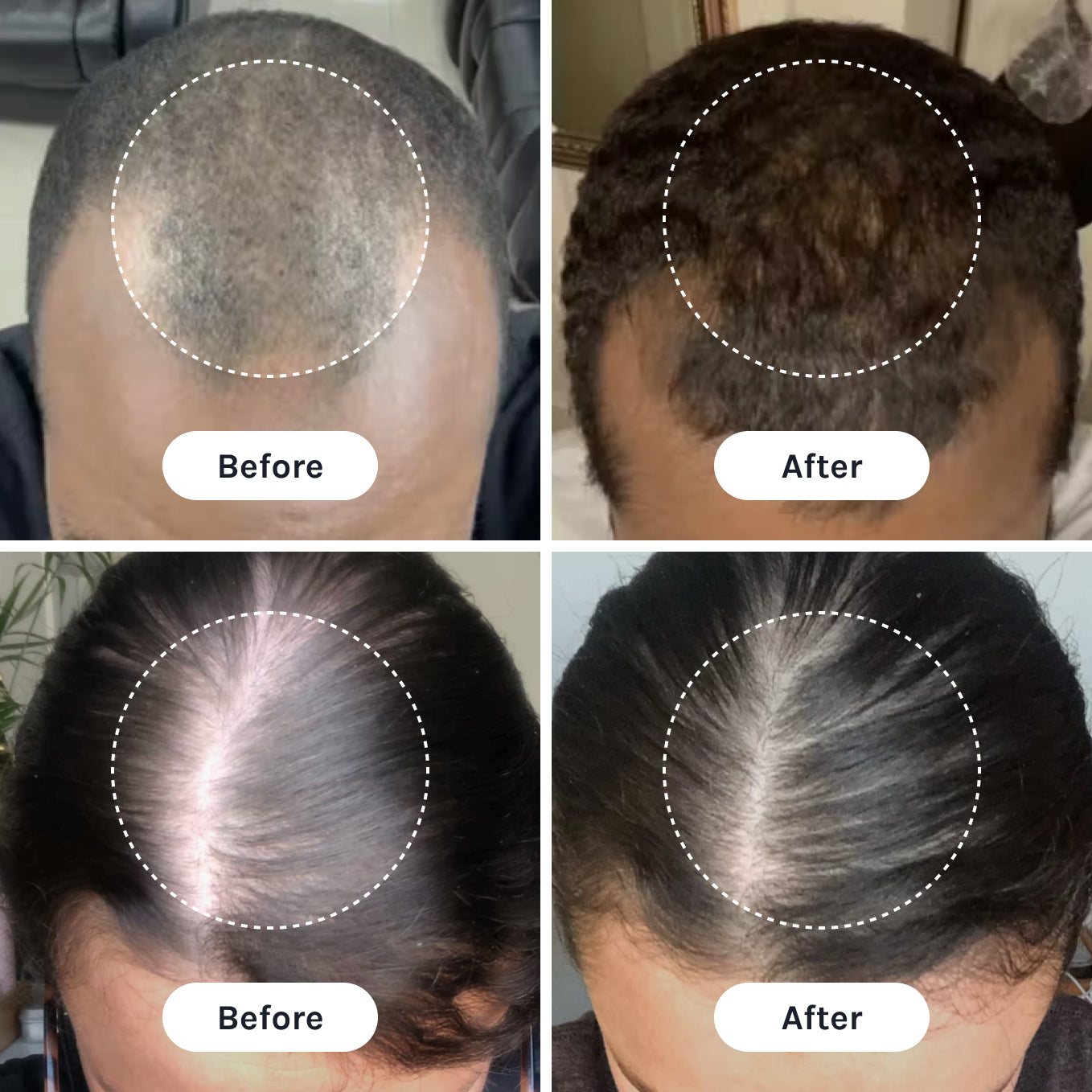 Before-and-after comparison graphic showing scalp and hair density photos for two individuals with highlighted treatment area