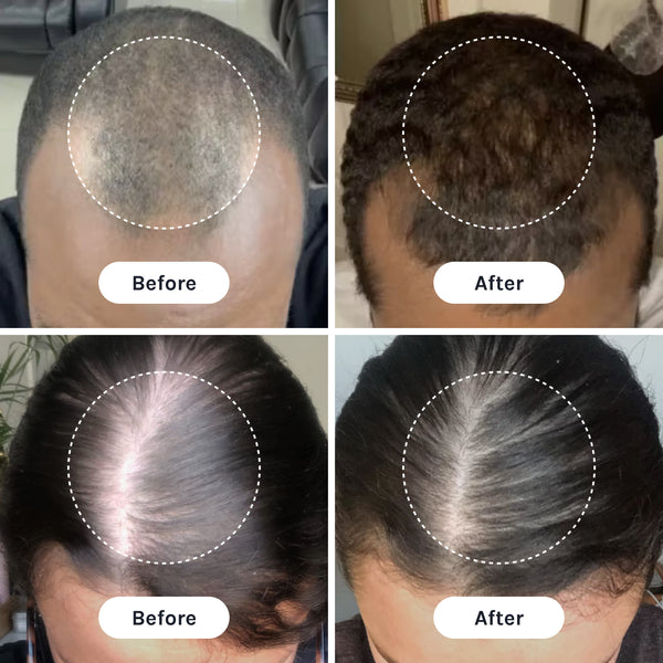 Before-and-after comparison graphic showing scalp and hair density photos for two individuals with highlighted treatment area